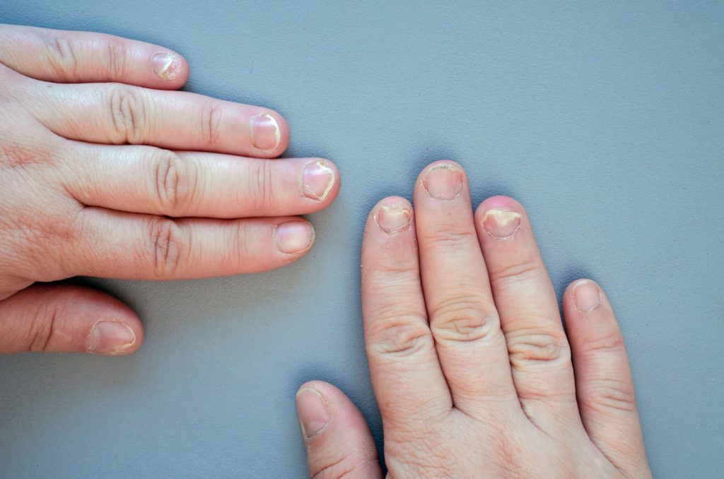 grzybica paznokci dermest
